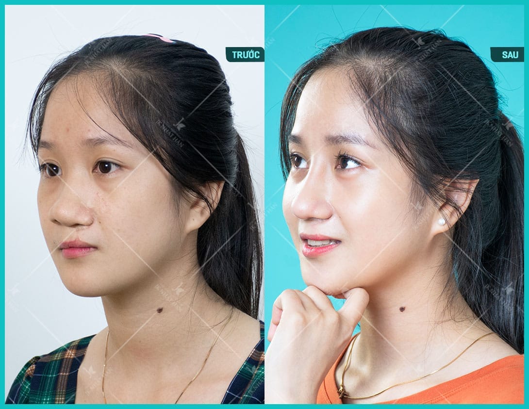 nguyen-nhan-sut-moi-ho-ham-ech-2-ben-trieu-chung-va-giai-phap-can-thiep-cai-thien