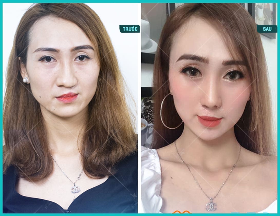 nguyen-nhan-sut-moi-ho-ham-ech-2-ben-trieu-chung-va-giai-phap-can-thiep-cai-thien