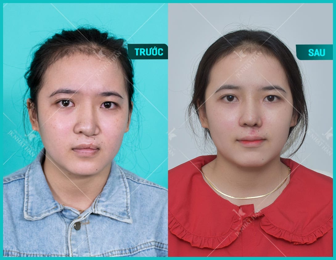 nguyen-nhan-sut-moi-ho-ham-ech-2-ben-trieu-chung-va-giai-phap-can-thiep-cai-thien