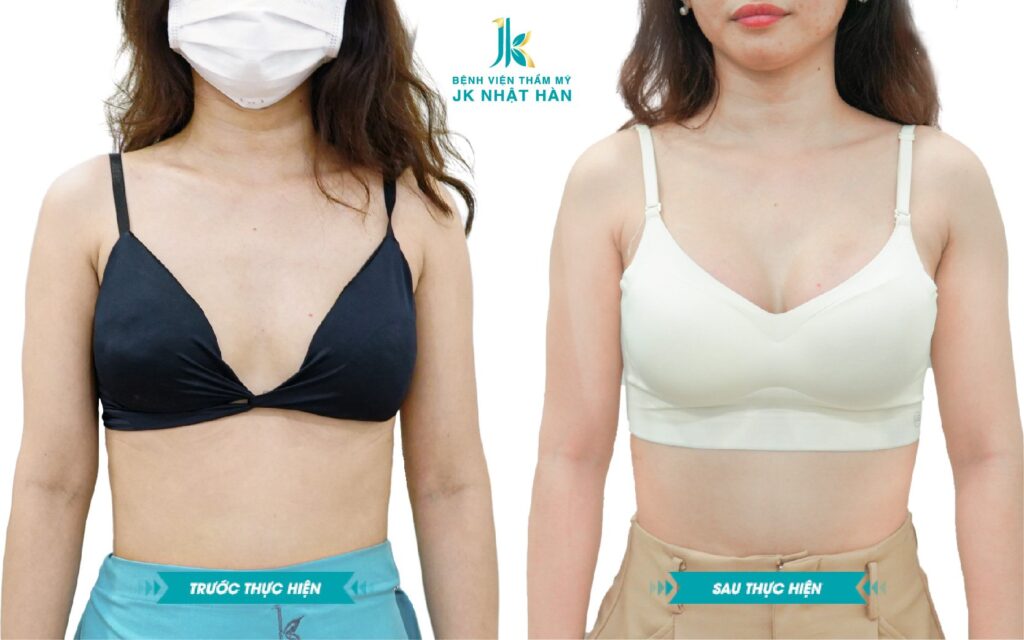 Khách hàng nâng ngực nội soi sau 2 tháng