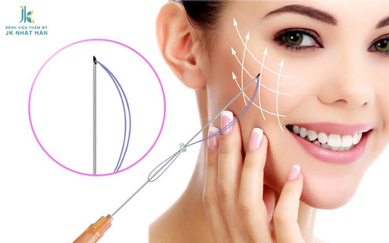 Phương pháp Căng chỉ trẻ hóa da mặt
