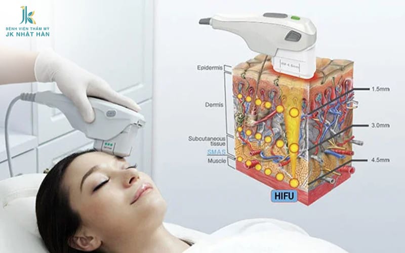 Phương pháp Hifu trẻ hóa da mặt