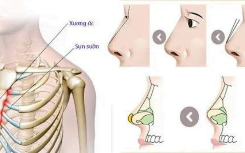 Nâng mũi sụn sườn là gì? Ưu điểm của nâng mũi sụn sườn