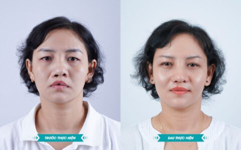 dia-chi-phau-thuat-tham-my-ho-ham-ech-cho-nguoi-truong-thanh