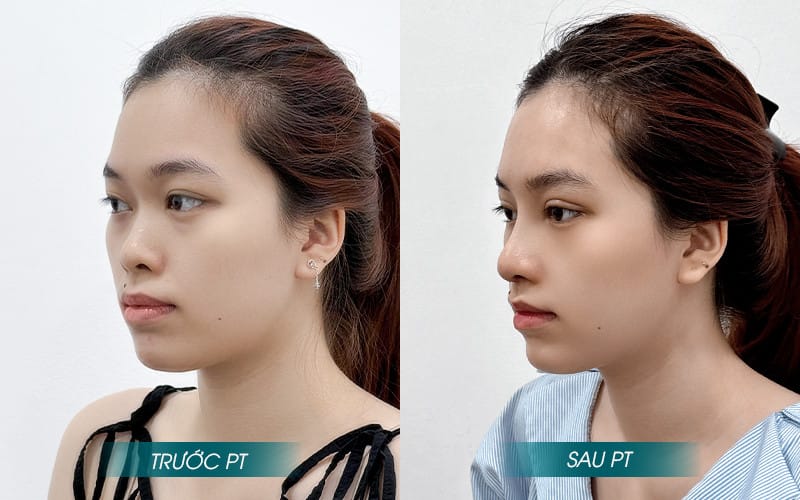Nâng mũi sụn sườn là gì? Ưu điểm của nâng mũi sụn sườn