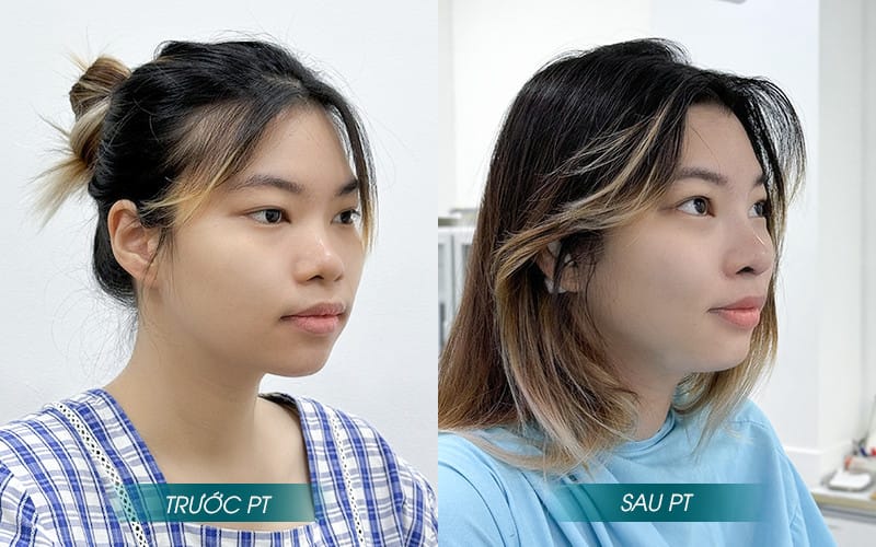 Nâng mũi sụn sườn là gì? Ưu điểm của nâng mũi sụn sườn