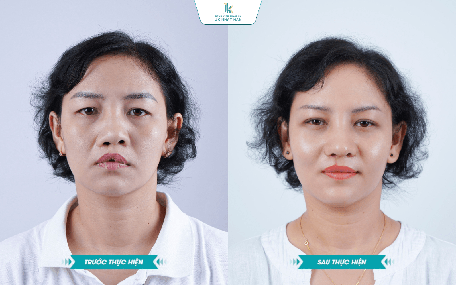 lua-tuoi-nao-co-the-phau-thuat-sua-moi
