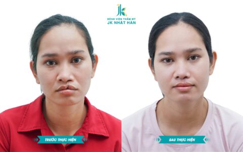 phau-thuat-tham-my-moi-bi-sut-va-nhung-dieu-can-biet