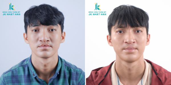 dia-chi-phau-thuat-tham-my-ho-ham-ech-cho-nguoi-truong-thanh