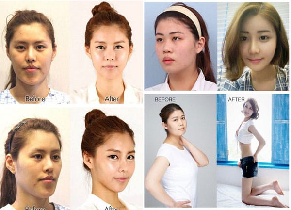 chi-phi-nang-mui-tai-han-quoc-va-mot-so-luu-y-quan-trong