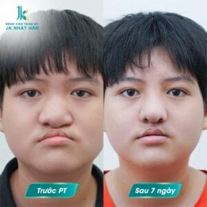 phau-thuat-tham-my-moi-bi-sut-va-nhung-dieu-can-biet