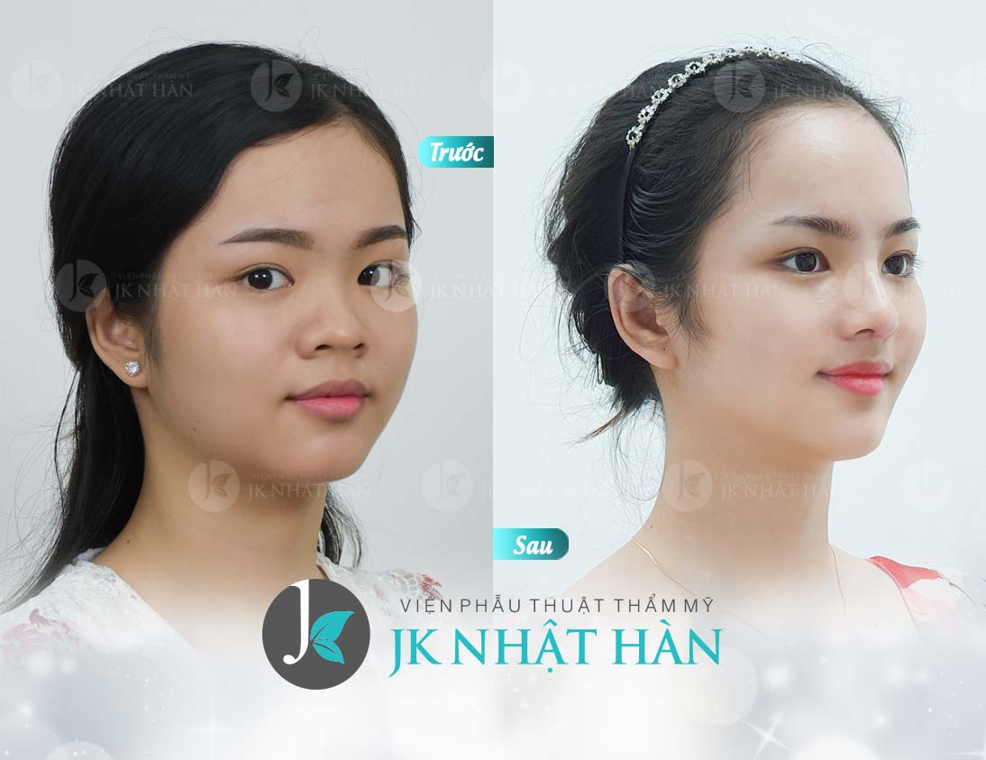 hình ảnh nâng mũi hàn quốc tại viện thẩm mỹ jk nhật hàn