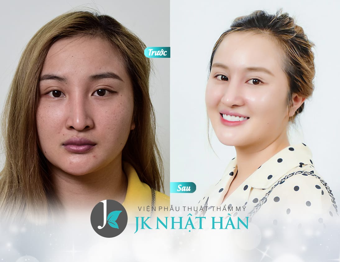 hinh-anh-truoc-sau-sua-mui-hong-2