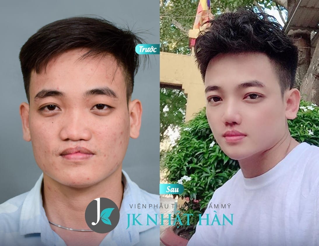 phẫu thuật sứt môi hở hàm ếch cho tuổi trưởng thành