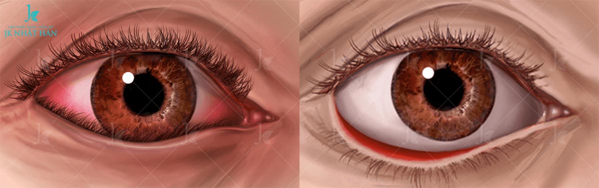 mo-phong-mat-bi-lat-mi