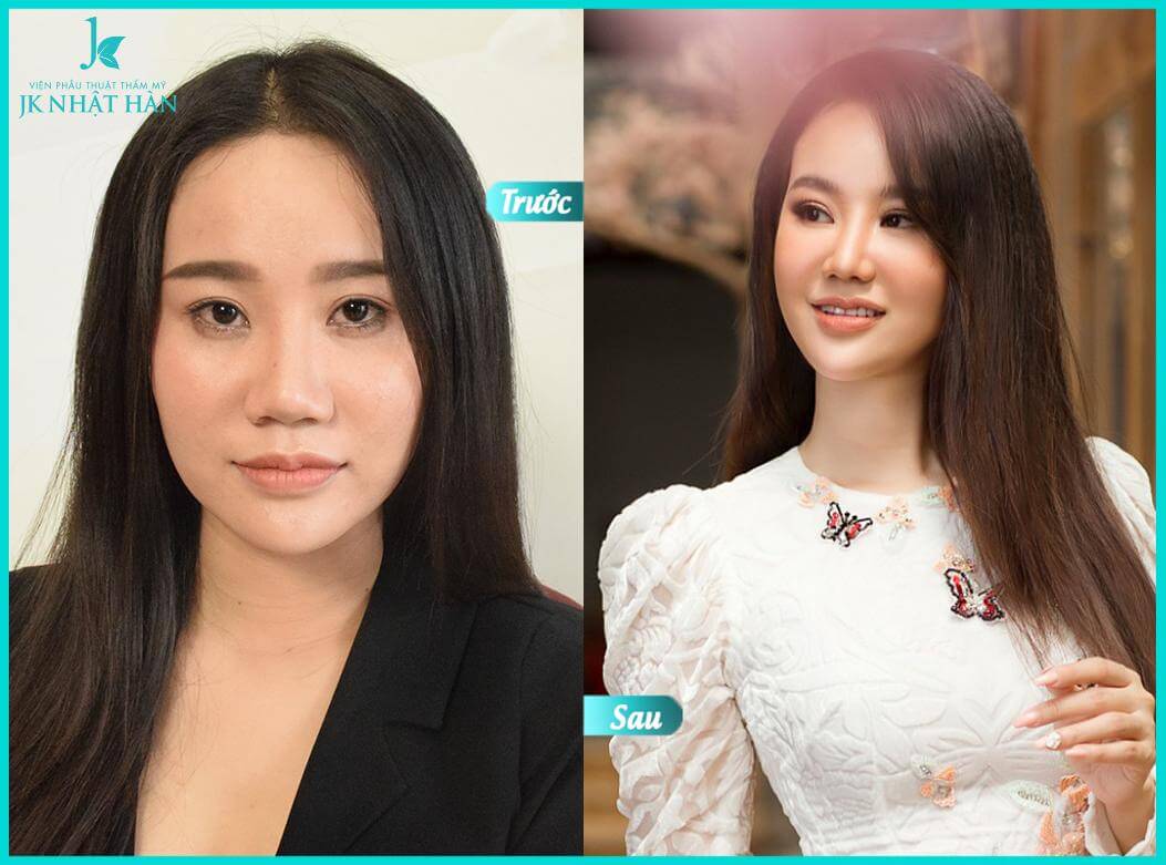 Hình ảnh nhấn mí mắt làm nhiều người bất ngờ