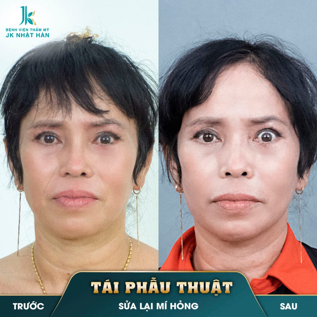 Đào Ngọc Thoa Mắt hỏng 3