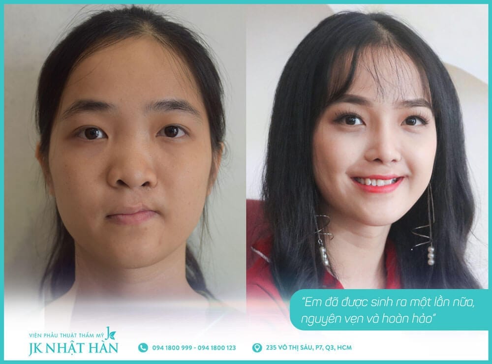 Khách hàng sau khi thực hiện phũa thuật smhhe