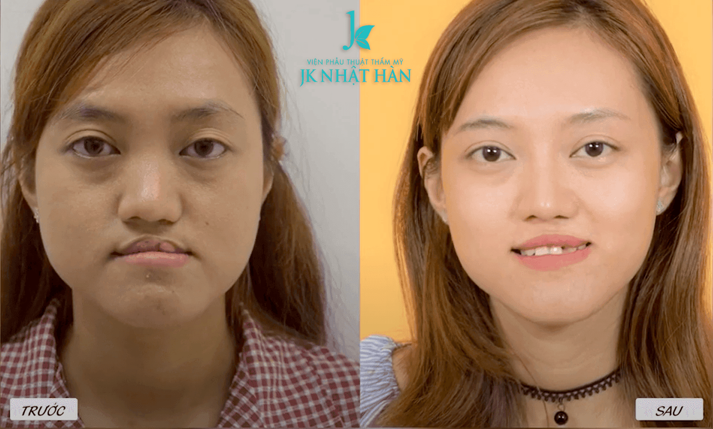 Before After Ngoc Tram