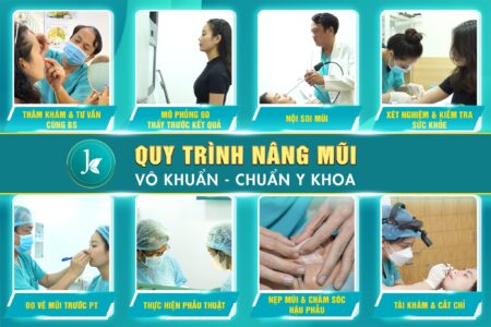 Nâng mũi cấu trúc