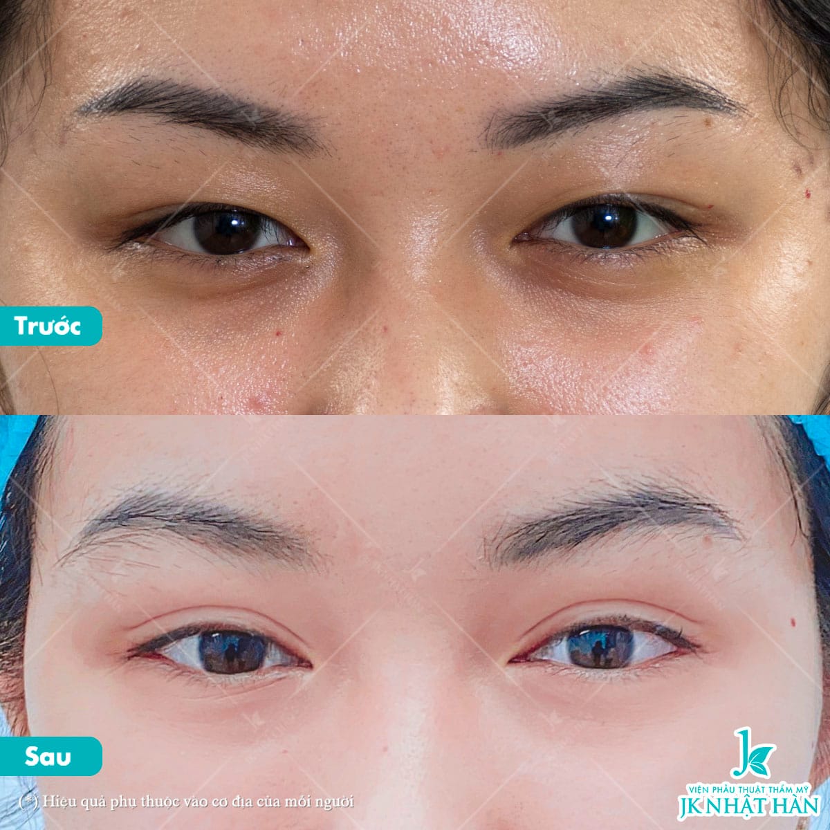 Thẩm mỹ cắt mí mắt có được vĩnh viễn không?