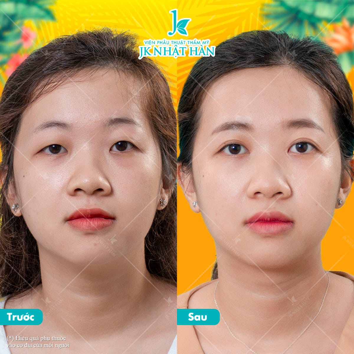 Thẩm mỹ cắt mí mắt có được vĩnh viễn không?