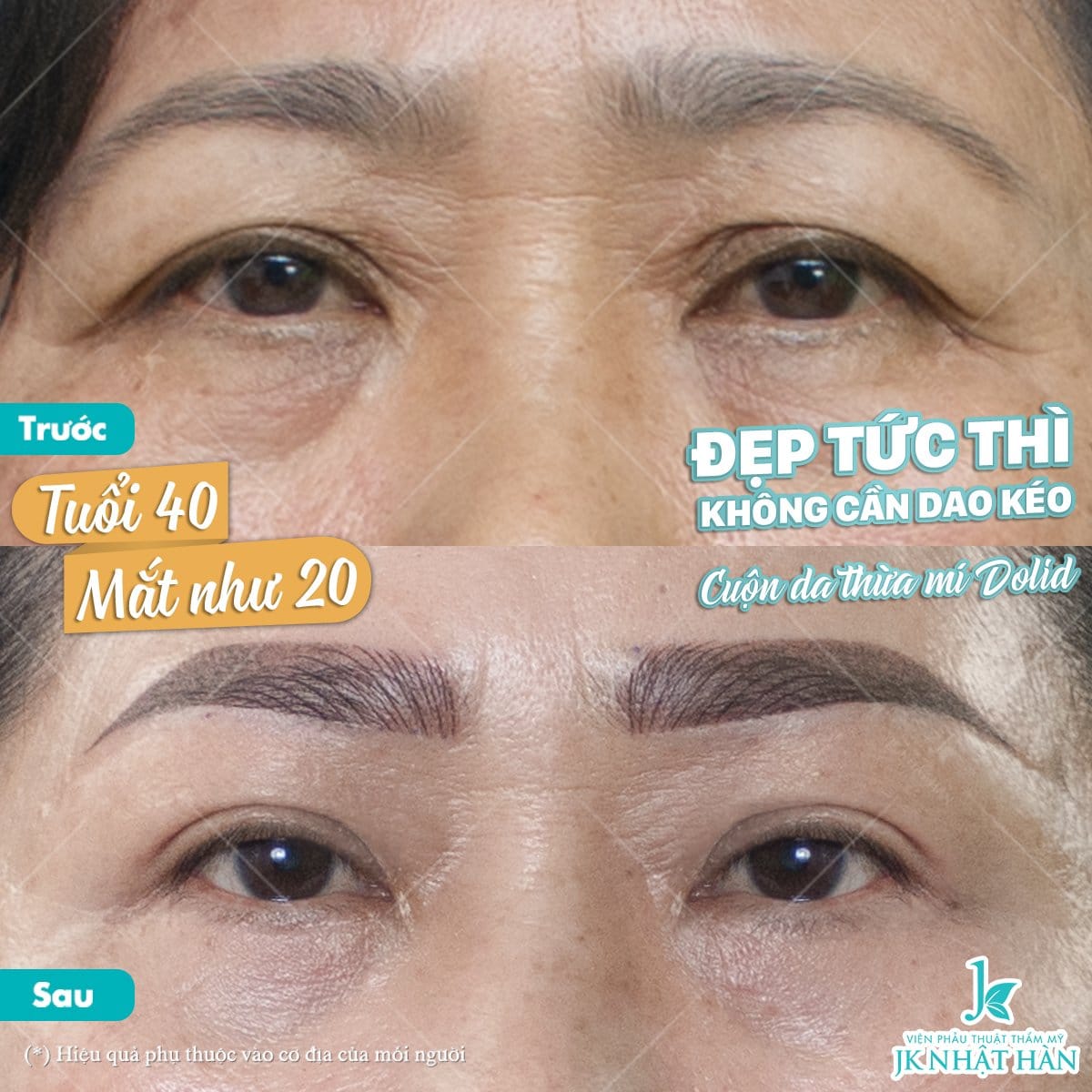 Các loại mắt và cách cải thiện thẩm mỹ hiệu quả nhất