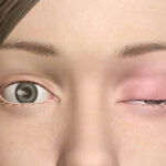 Nguyên nhân sụp mí mắt là gì? Cách khắc phục sụp mí mắt.