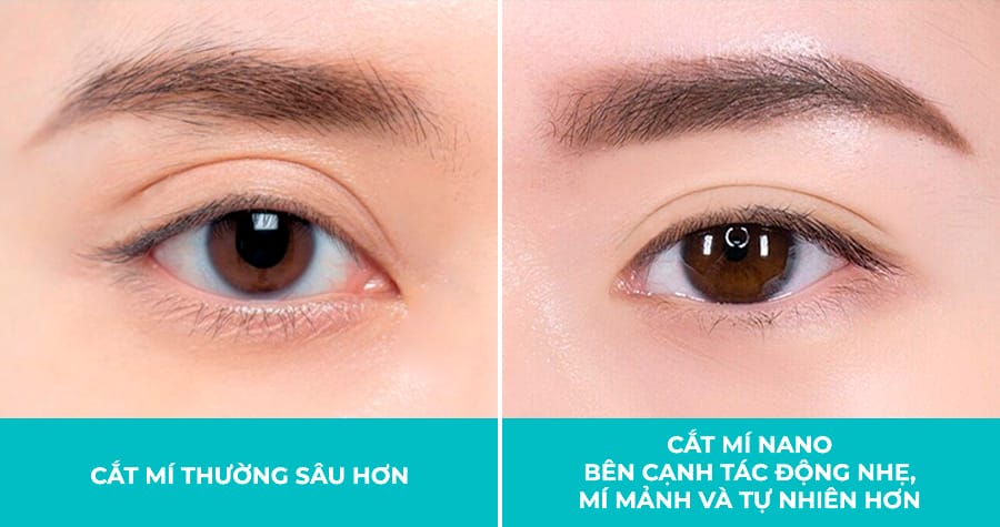 Cắt mí Nano-2
