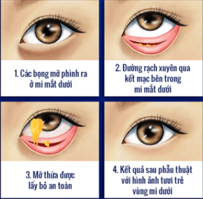 lấy bọng mỡ dưới mắt -5