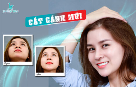 Nếu thẩm mỹ cắt cánh mũi có mất lộc không?