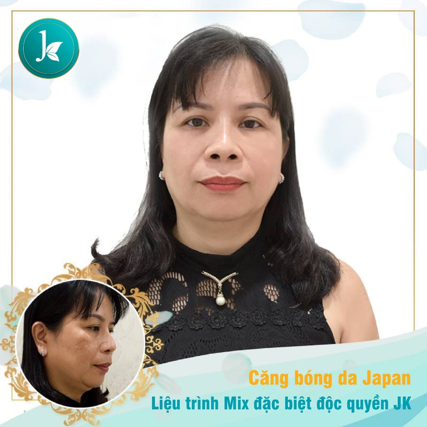 Hình Ảnh trước và sau khi căng bóng da tại Bệnh viện Thẩm Mỹ JK