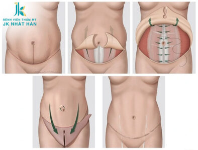 Tiến hành phẫu thuật, hút mỡ tạo hình thành bụng