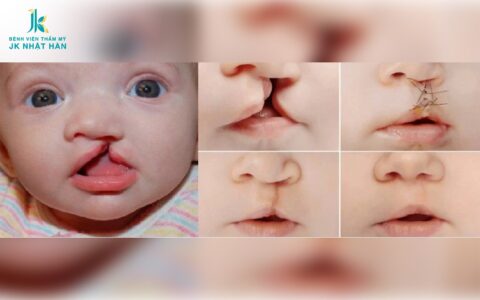 rẻ em bị dị tật sứt môi hở hàm ếch sẽ được chẩn đoán và điều trị sớm từ khi sinh ra 