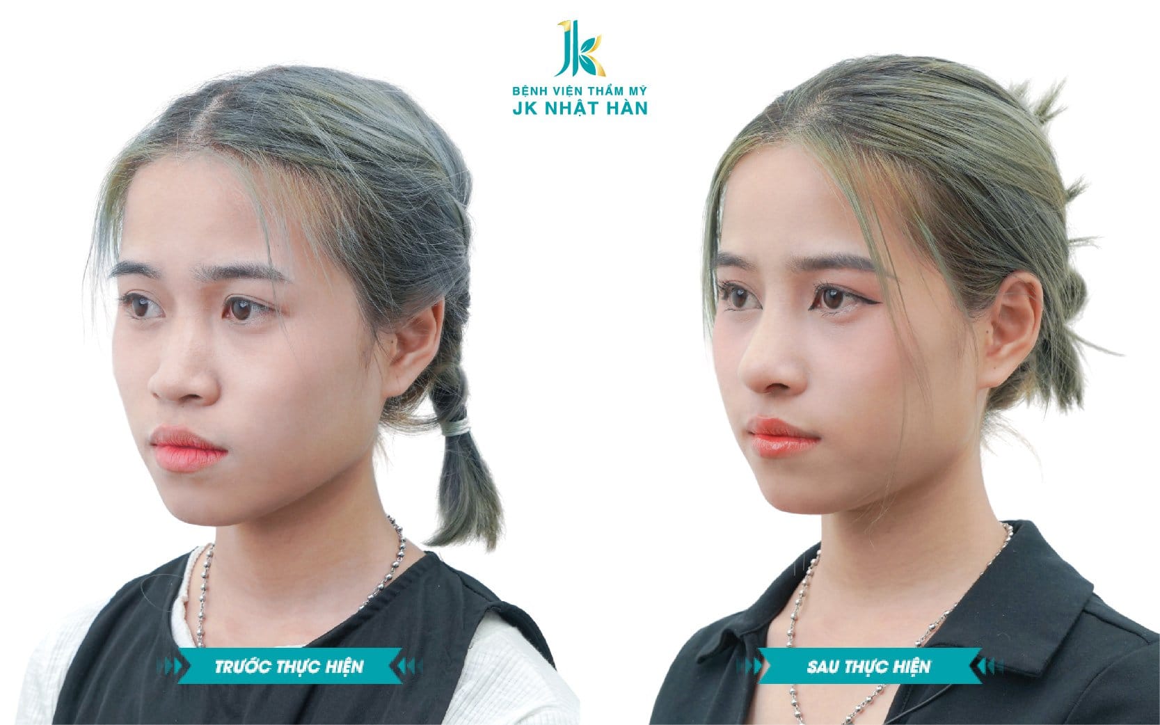 Nâng mũi bán cấu trúc và nâng mũi cấu trúc có gì khác nhau?