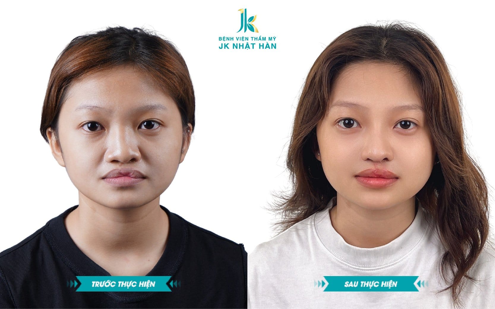 Giải pháp sửa môi bị sứt hiệu quả nhất hiện nay