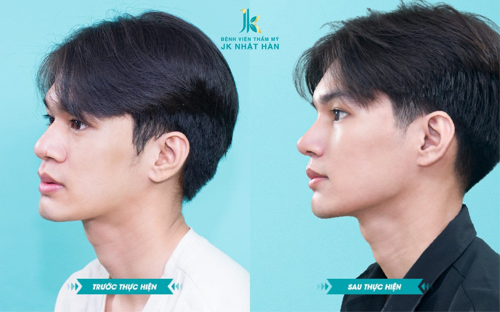 Xu hướng nâng mũi cao tự nhiên được nhiều bạn trẻ yêu thích