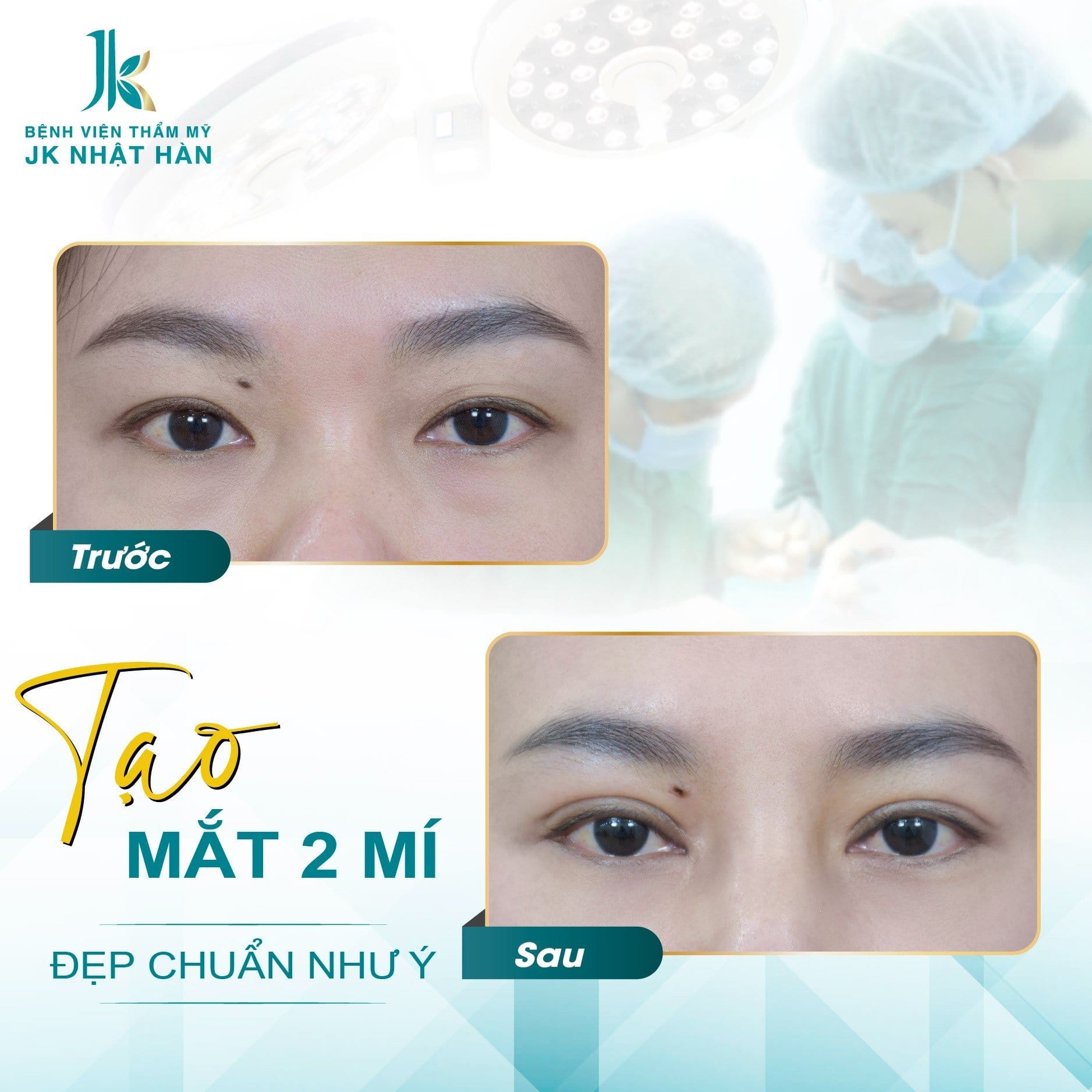 Nhấn mí có đau không? Nhấn mí giữ được bao lâu?