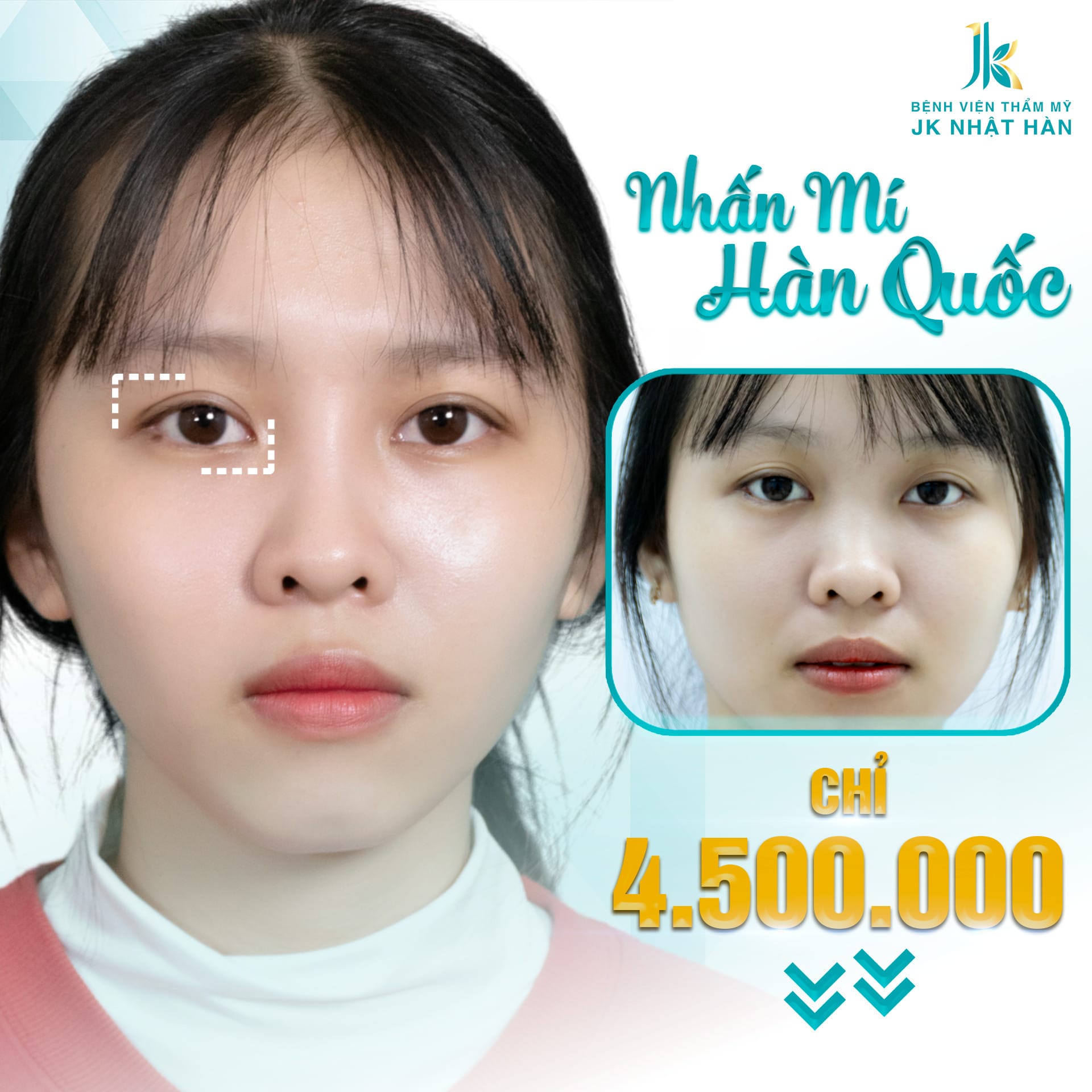 Nhấn mí có đau không? Nhấn mí giữ được bao lâu? Nhấn mí có đau không? Nhấn mí giữ được bao lâu?