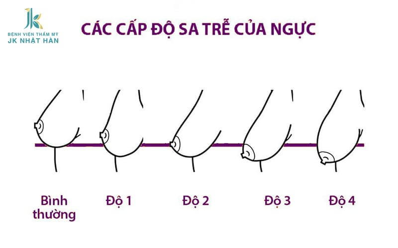 Các cấp độ sa trễ của ngực