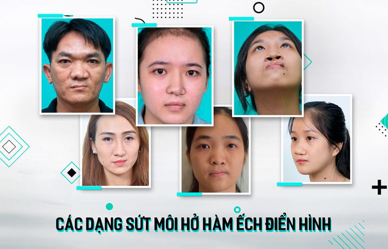 Giải pháp sửa môi bị sứt hiệu quả nhất hiện nay