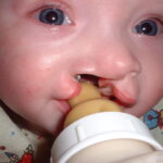 Những lưu ý về bình sữa dành cho trẻ sứt môi hở hàm ếch