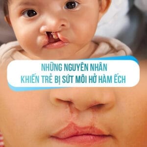 Những nguyên nhân khiến trẻ bị sứt môi hở hàm ếch