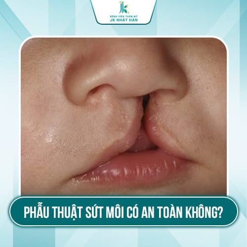 Phẫu thuật sứt môi có an toàn không?