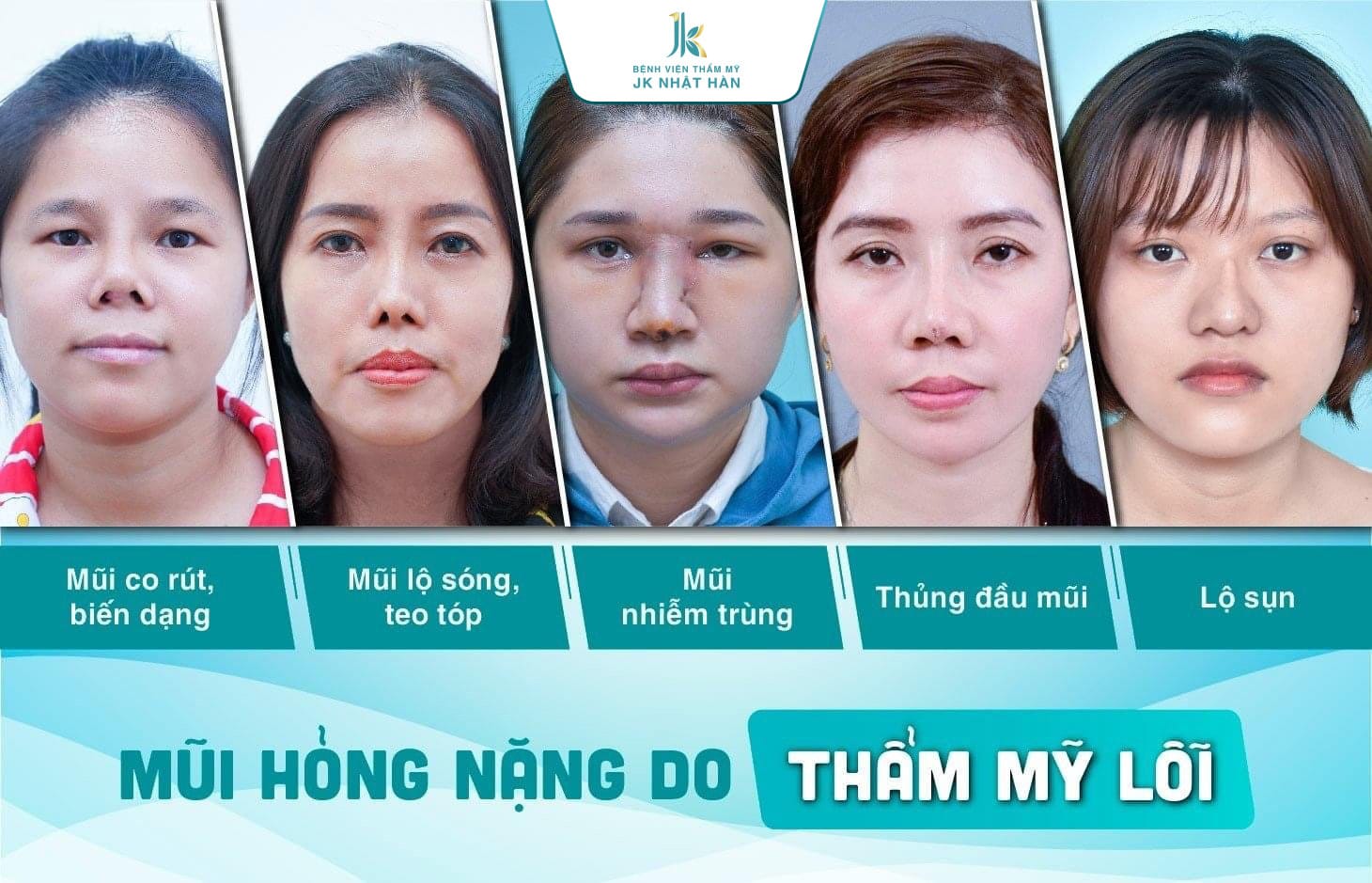 Những trường hợp mũi bị biến dạng