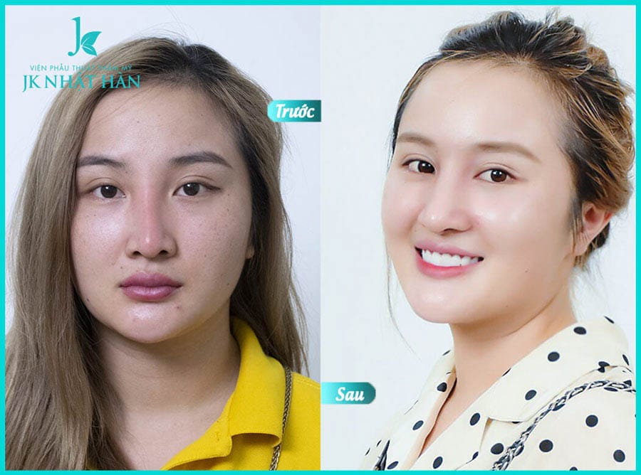 Phẫu thuật sửa mũi hỏng tại bệnh viện thẩm mỹ jk nhật hàn