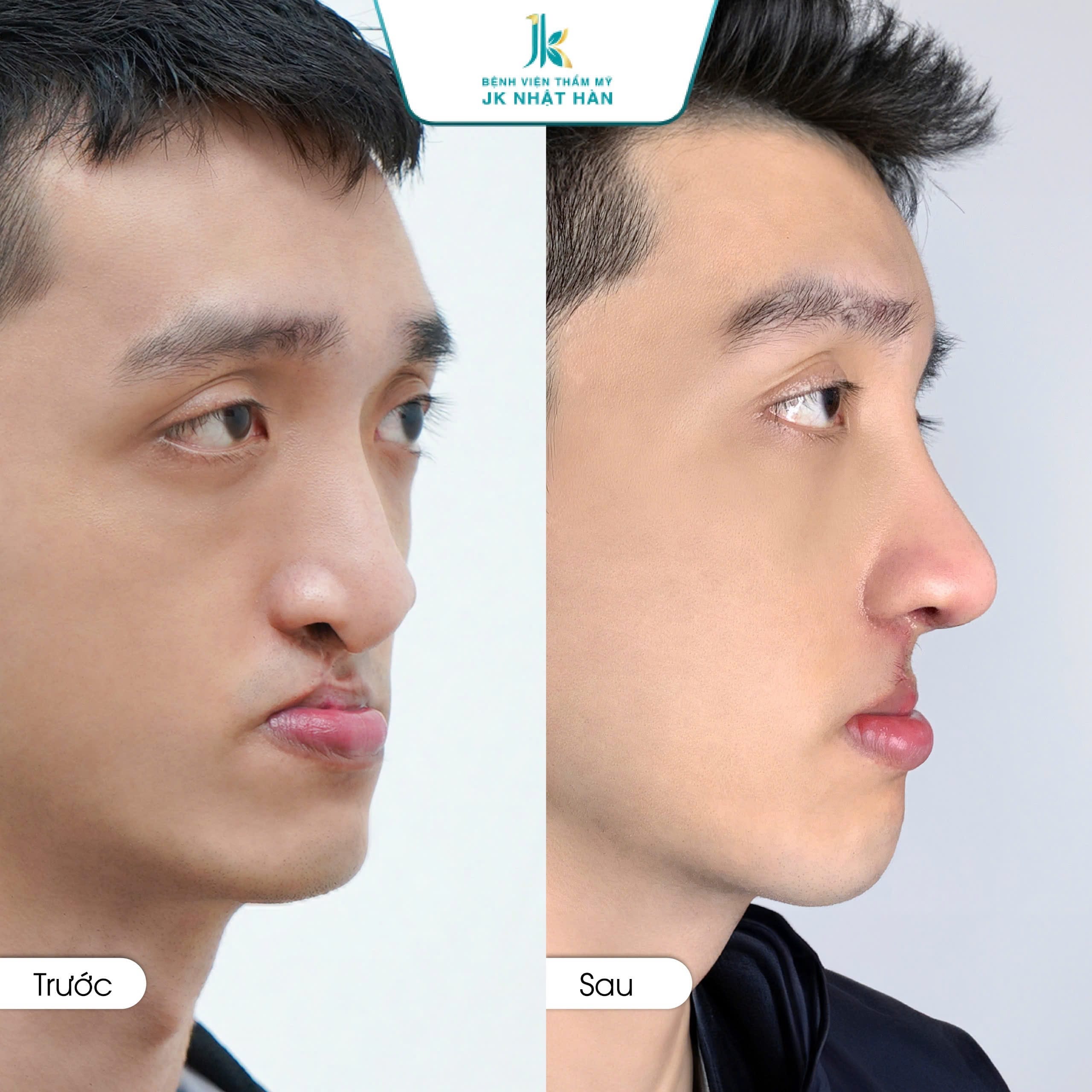 Tại sao cần phẫu thuật mũi sứt môi hở hàm ếch?