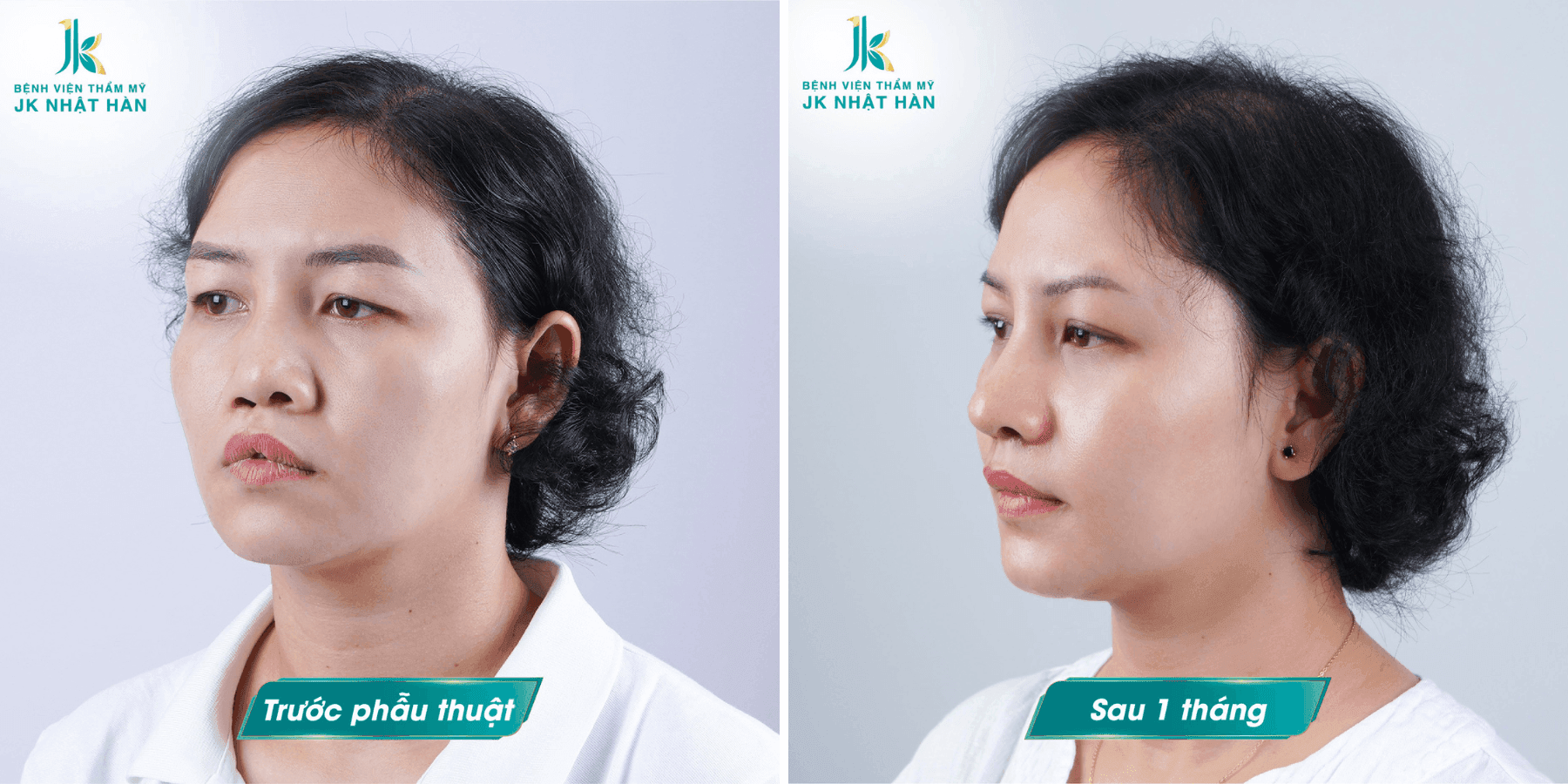 tuoi-nao-duoc-phau-thuat-sut-moi-ho-ham-ech