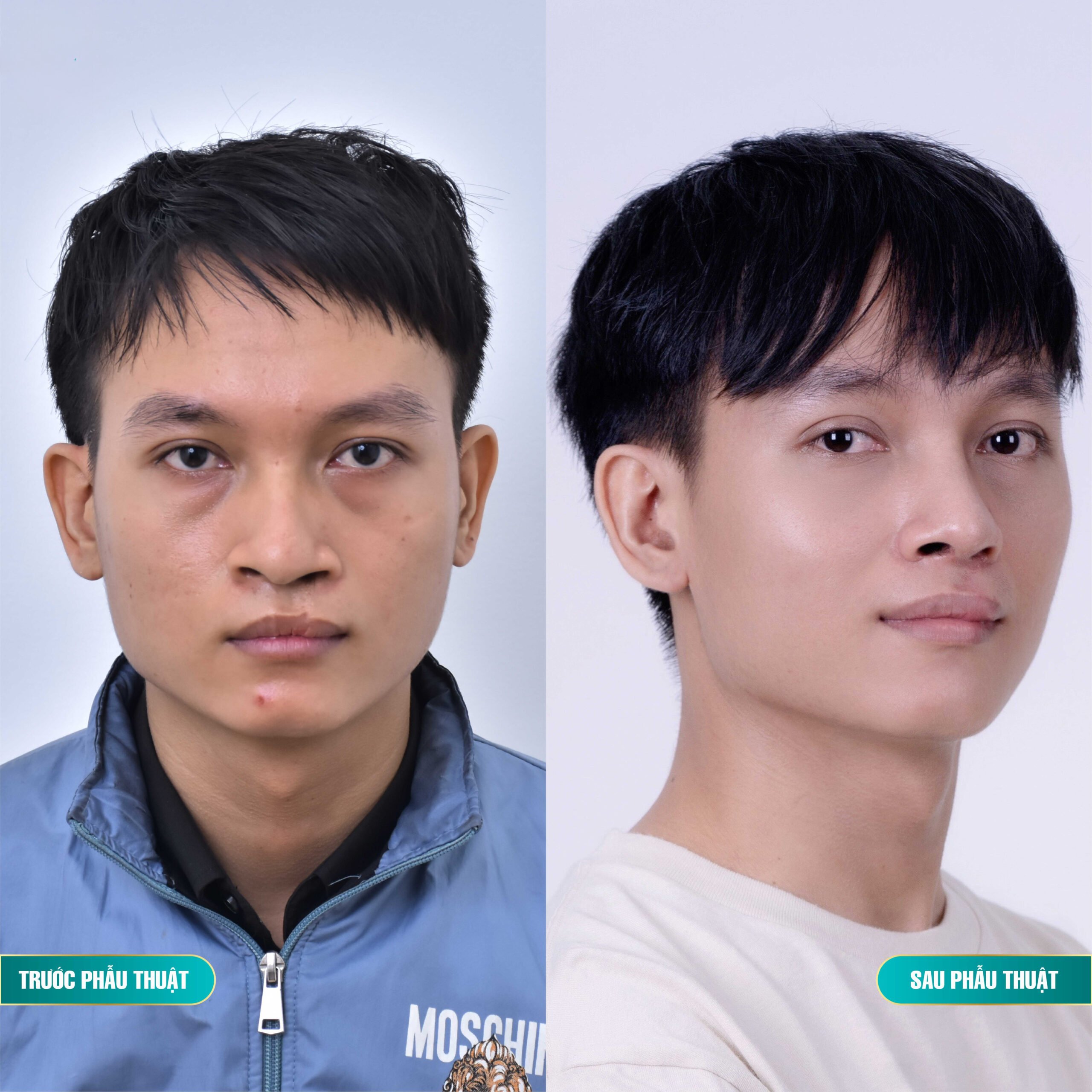 chi-phi-nang-mui-tai-han-quoc-va-mot-so-luu-y-quan-trong
