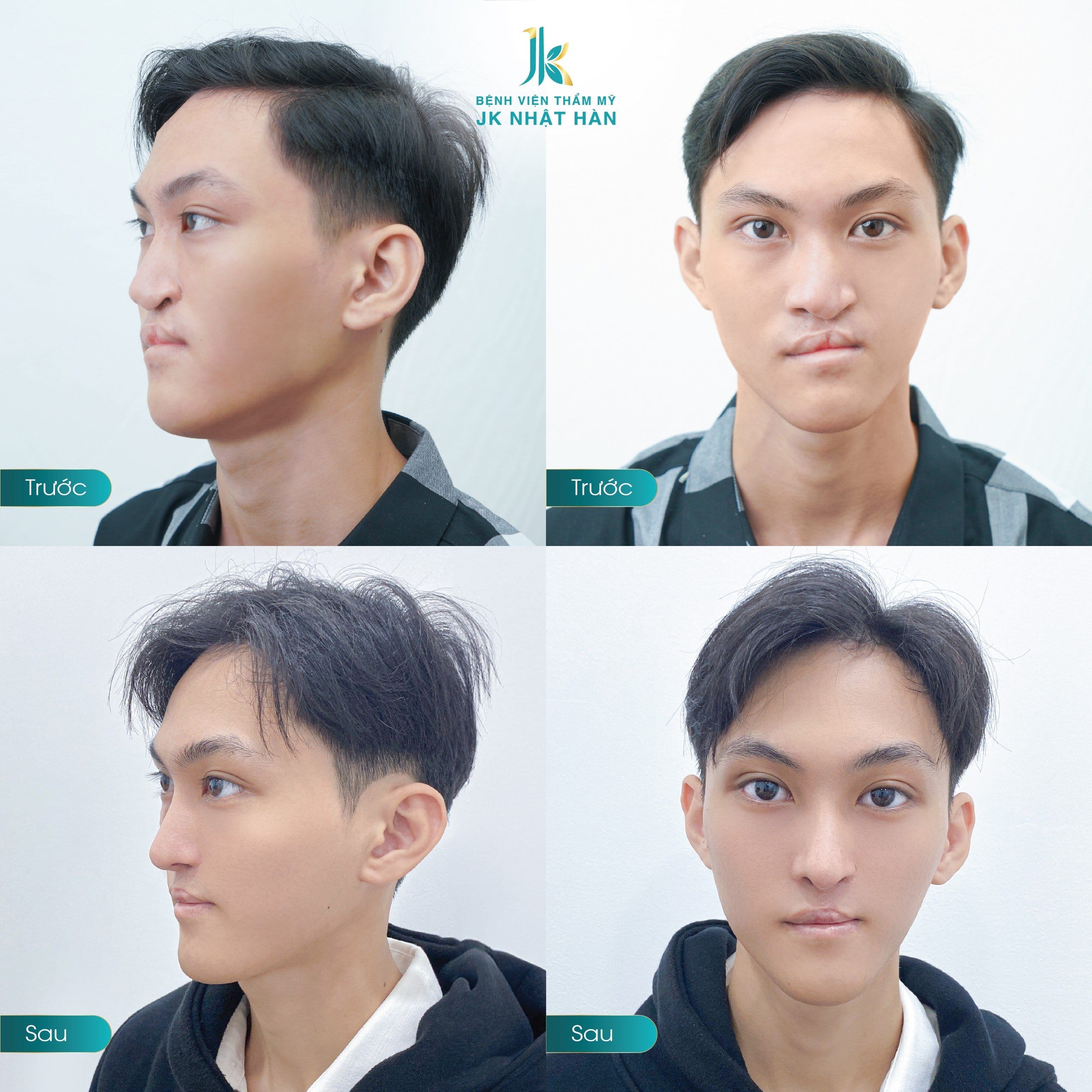 sut-moi-ho-ham-ech-nguyen-nhan-la-gi